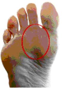 ball of foot pain big toe
